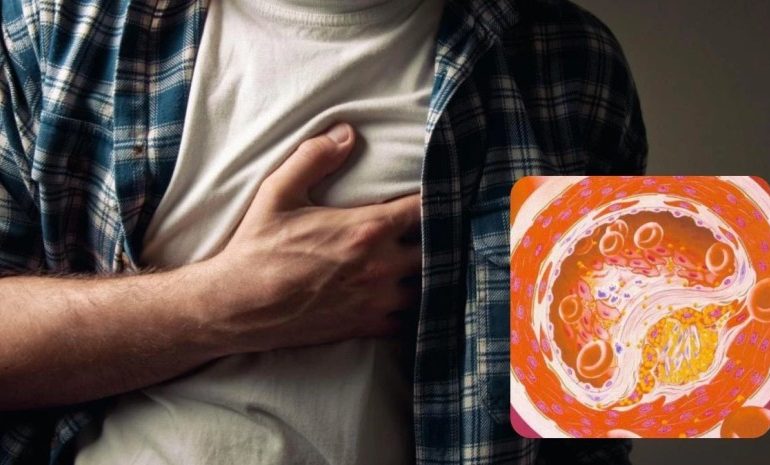 დადგენილია სიმპტომები, რომელიც ინფარქტამდე, ან ინსულტამდე რამდენიმე წლით ადრე ვლინდება – კვლევა