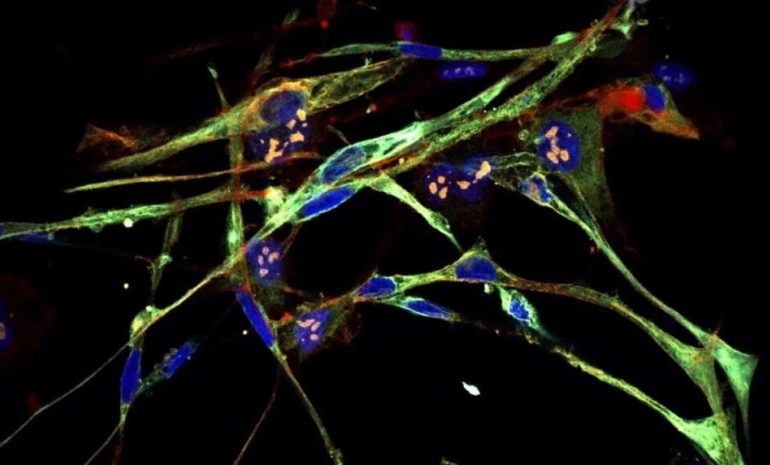 სიმპტომები, რომლებიც შეიძლება ახასიათებდეს პანკრეასის კიბოს