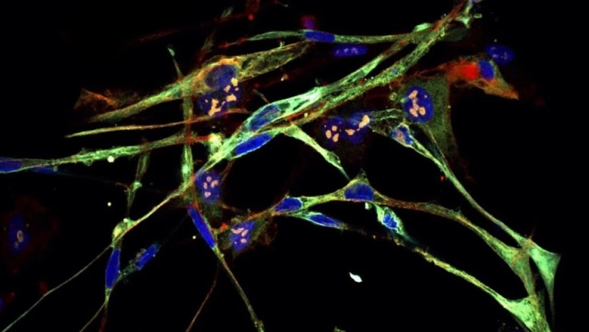 სიმპტომები, რომლებიც შეიძლება ახასიათებდეს პანკრეასის კიბოს