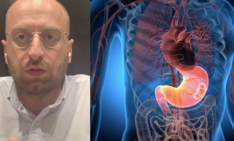 რა შანსია დაგვემართოს სიმსივნე, როცა კუჭ-ნაწლავის პრობლემები გვაქვს – გასტროენტეროლოგი განმარტავს