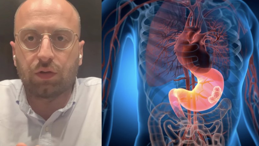 რა შანსია დაგვემართოს სიმსივნე, როცა კუჭ-ნაწლავის პრობლემები გვაქვს – გასტროენტეროლოგი განმარტავს